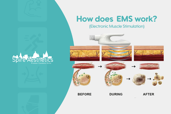 EMS treatment for post pregnancy weight loss treatment Coventry