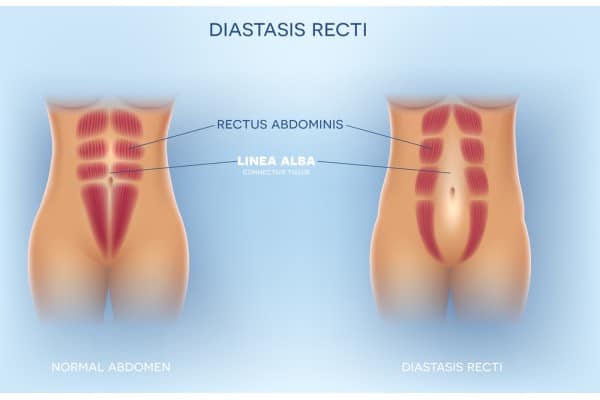 What Non-Surgical Options Are Available for Diastasis Recti Coventry?