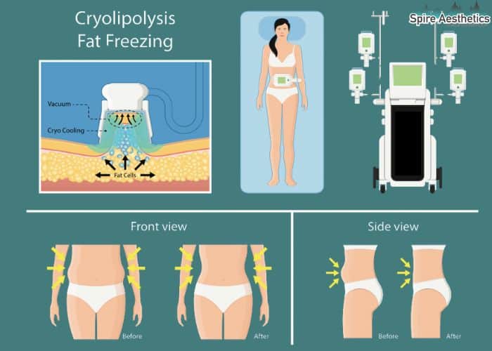 Image of diet and fat freezing combined for best results for Spire Aesthetics Coventry
