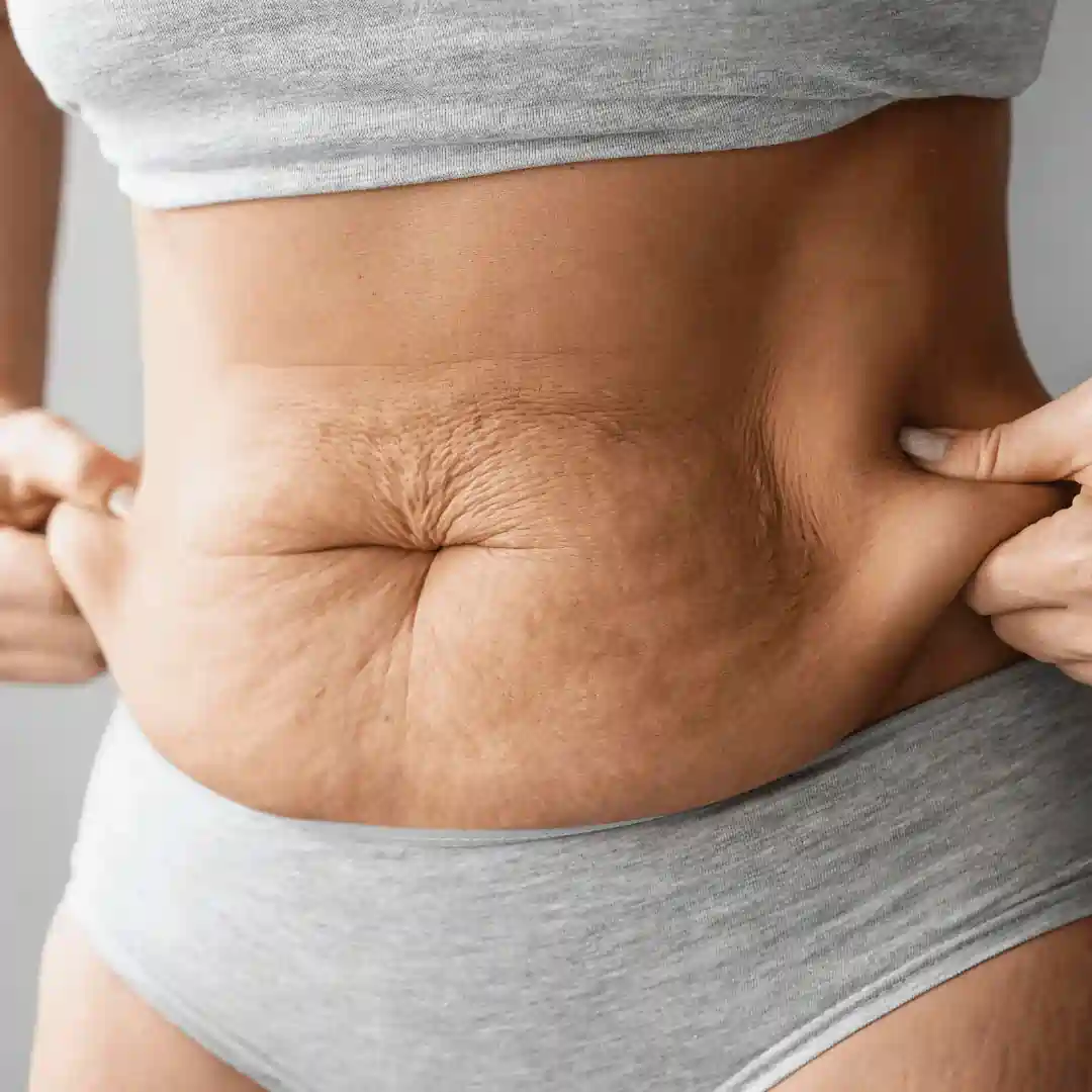 Is It Normal to Have Loose Skin After Pregnancy Coventry?