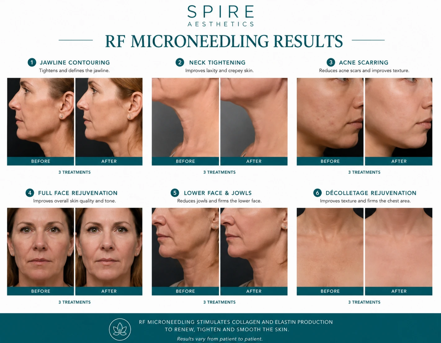 RF Microneedling Skin tightening Coventry results