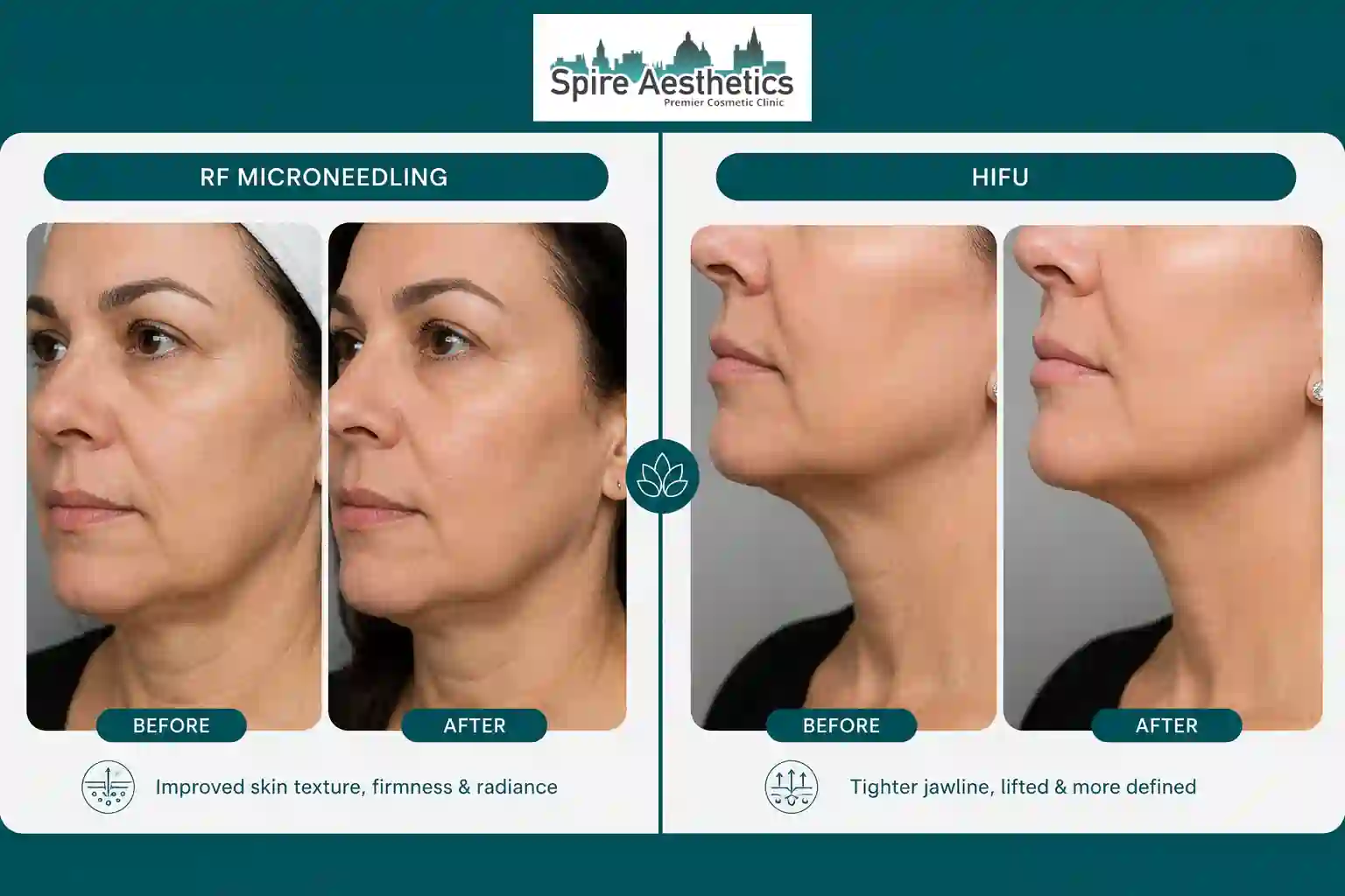 Can RF Microneedling and HIFU Be Combined Coventry?