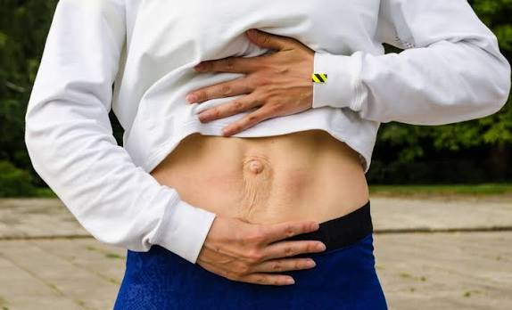 When Could Diastasis Recti Be the Missing Piece of the Puzzle Coventry?