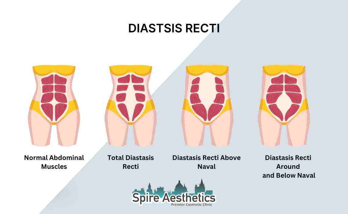 Is Non-Surgical Diastasis Recti Treatment Right for You? Common Concerns Answered Coventry
